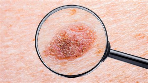 cáncer de piel - carne de panela